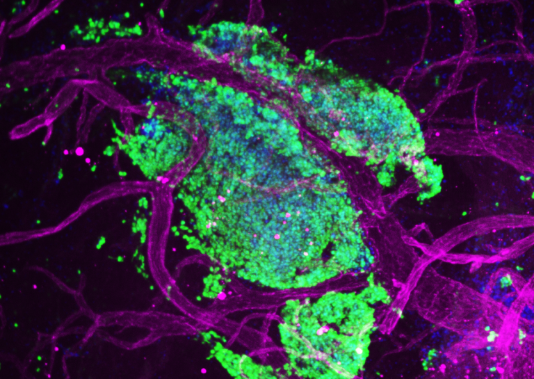 Blood vessels (magenta) intertwined with metastatic medulloblastoma tumor cells (green) nestled within the protective layers that surround the mouse spinal cord.